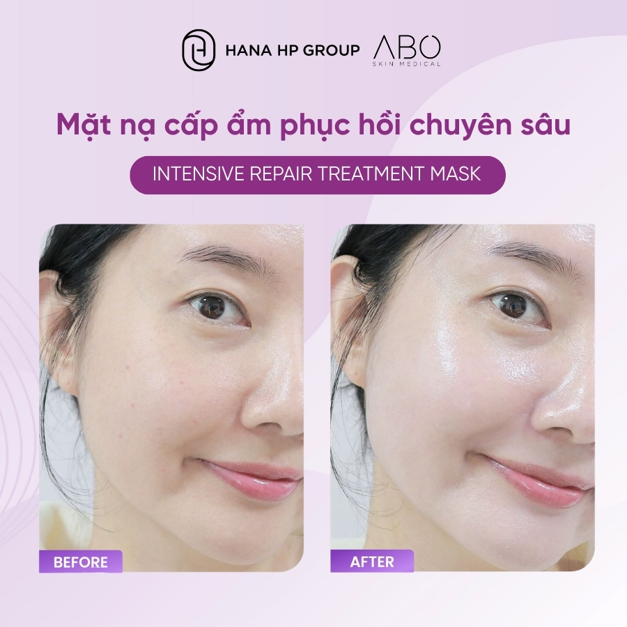 mặt nạ ABO