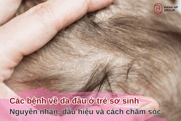 các bệnh về da đầu của trẻ sơ sinh