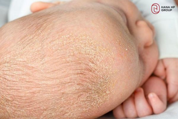các bệnh về da đầu của trẻ sơ sinh
