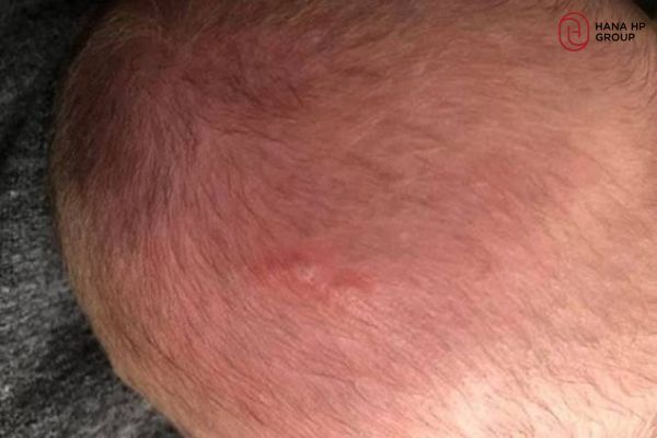 các bệnh về da đầu của trẻ sơ sinh