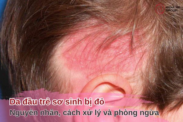 da đầu trẻ sơ sinh bị đỏ