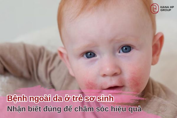 Bệnh ngoài da ở trẻ sơ sinh