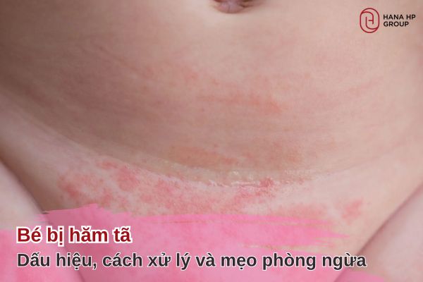 Bé bị hăm tã