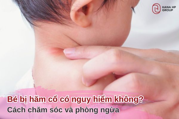 bé bị hăm cổ
