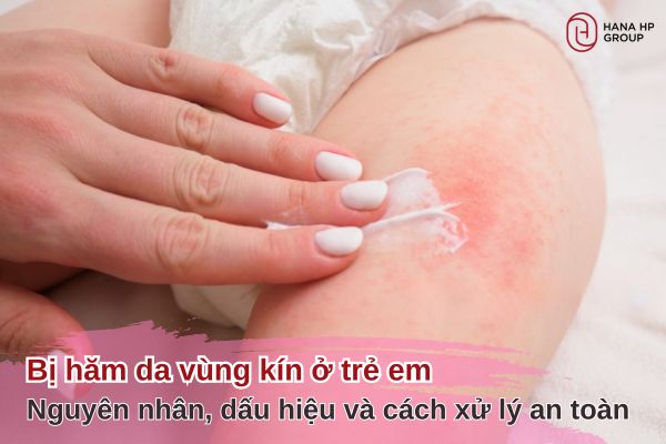 bị hăm da vùng kín ở trẻ em