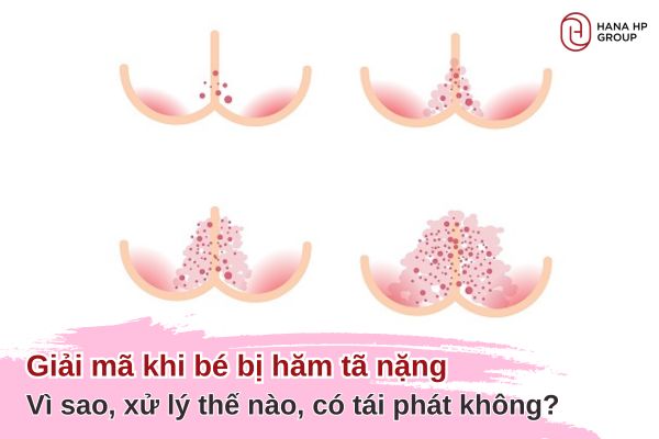 bé bị hăm tã nặng