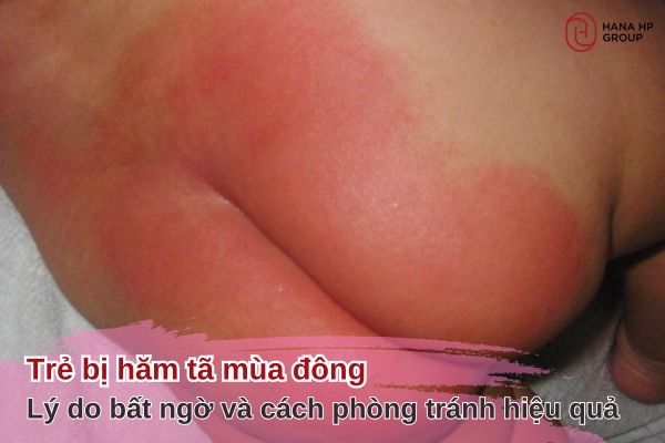 trẻ bị hăm tã mùa đông