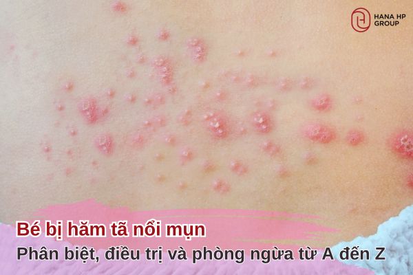 hăm tã nổi mụn