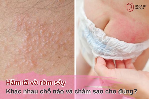 hăm tã và rôm sảy
