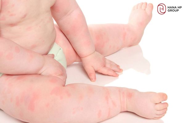 sữa tắm cho bé bị dị ứng