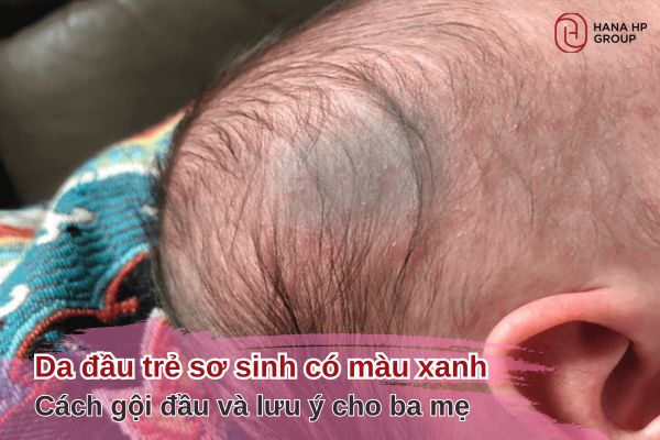 da đầu trẻ sơ sinh có màu xanh
