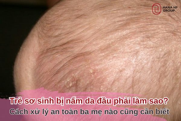 trẻ sơ sinh bị nấm da đầu phải làm sao