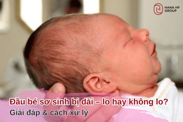 đầu trẻ sơ sinh bị dài