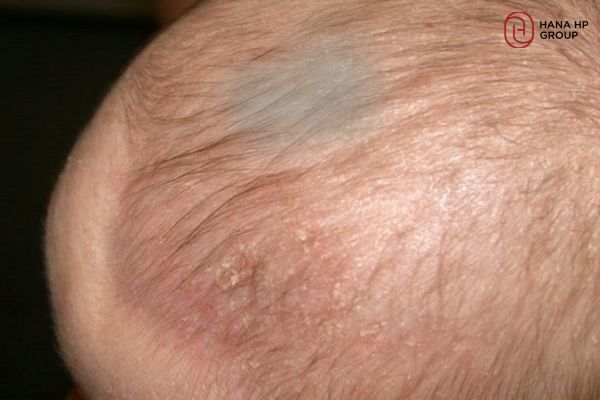 da đầu trẻ sơ sinh có màu xanh