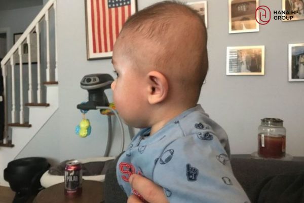 đầu trẻ sơ sinh bị dài