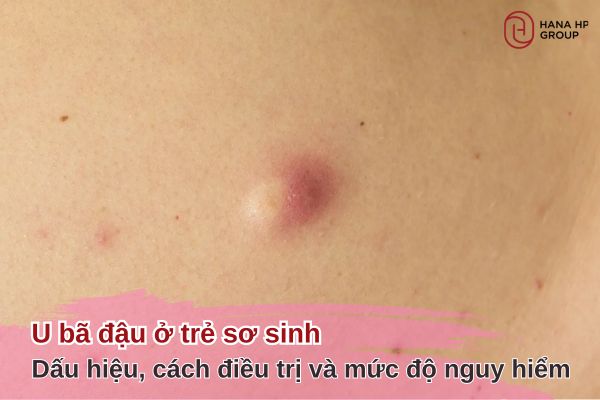 u bã đậu ở trẻ sơ sinh