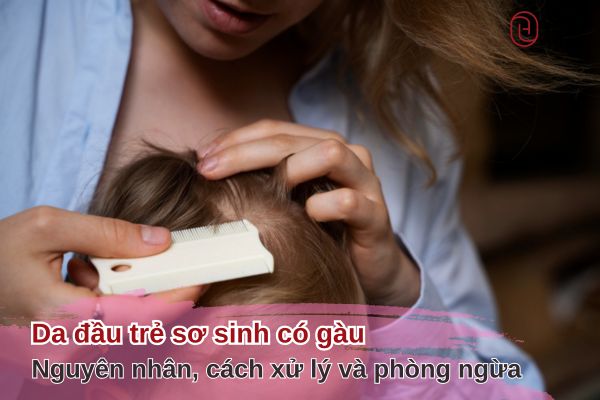 da đầu trẻ sơ sinh có gàu