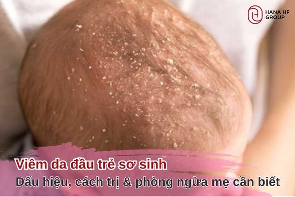 viêm da đầu trẻ sơ sinh