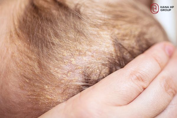 da đầu trẻ sơ sinh có gàu