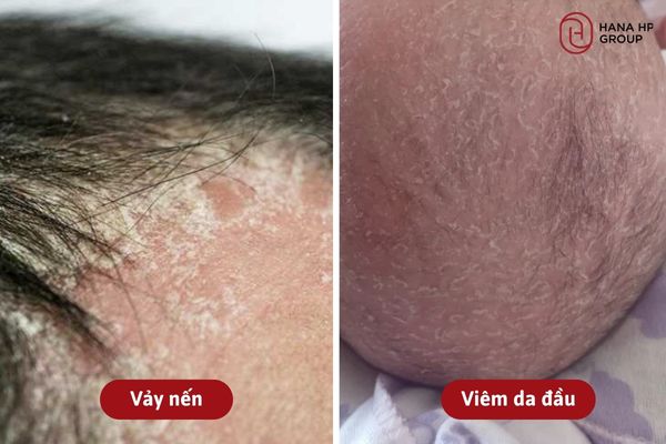 viêm da đầu trẻ sơ sinh