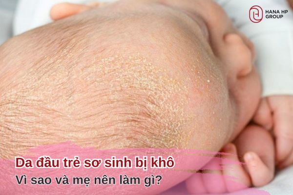 da đầu trẻ sơ sinh bị khô