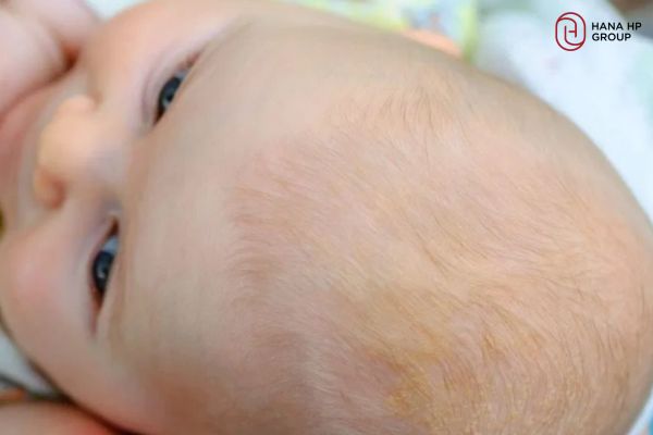 da đầu trẻ sơ sinh bị khô