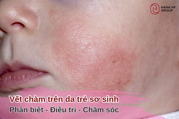 vết chàm trên da trẻ sơ sinh