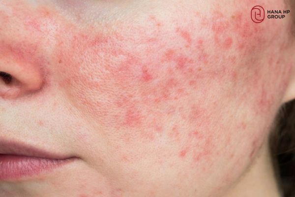 nên đắp mặt nạ khi nào