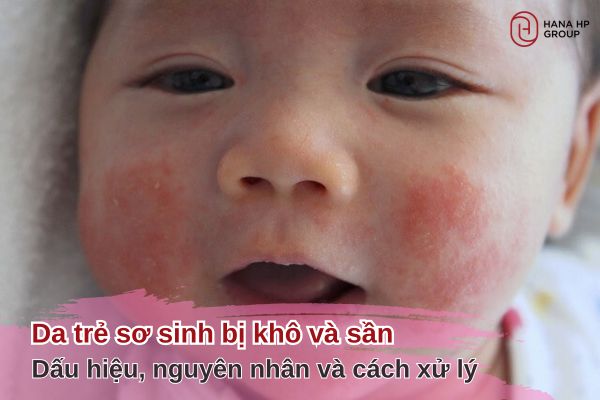 da trẻ sơ sinh bị khô và sần