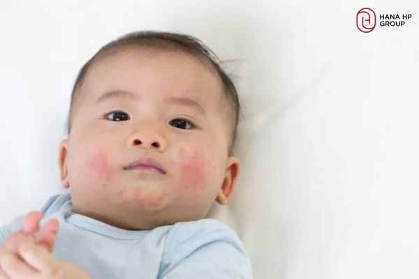 da trẻ sơ sinh bị khô và sần