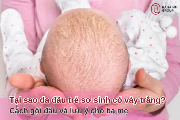 tại sao da đầu trẻ sơ sinh có vảy trắng
