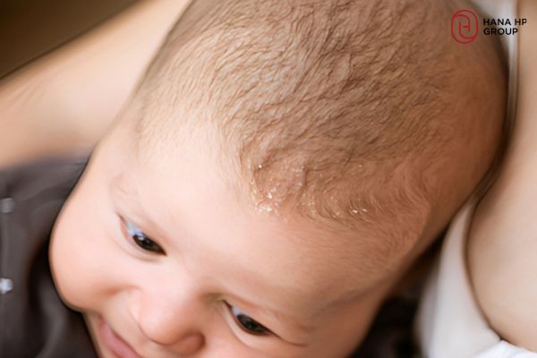 tại sao da đầu trẻ sơ sinh có vảy trắng