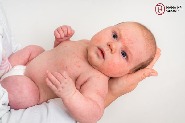 tác hại của corticoid với da trẻ sơ sinh