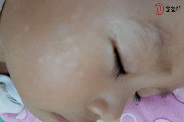 vết loang trắng trên da trẻ sơ sinh