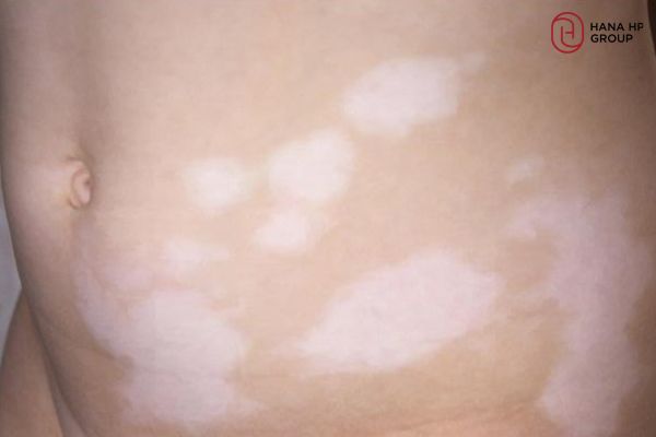 vết loang trắng trên da trẻ sơ sinh