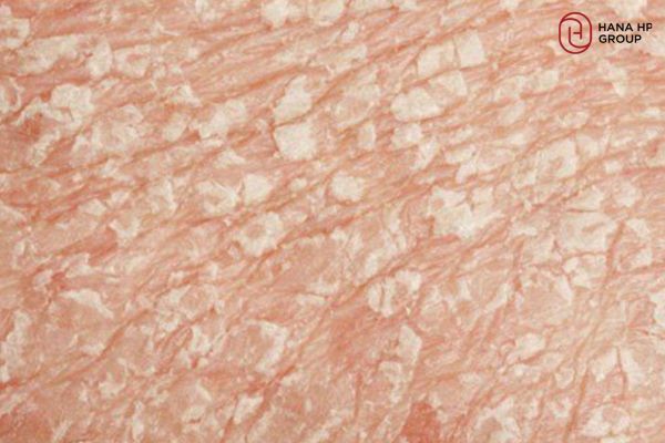 vết loang trắng trên da trẻ sơ sinh