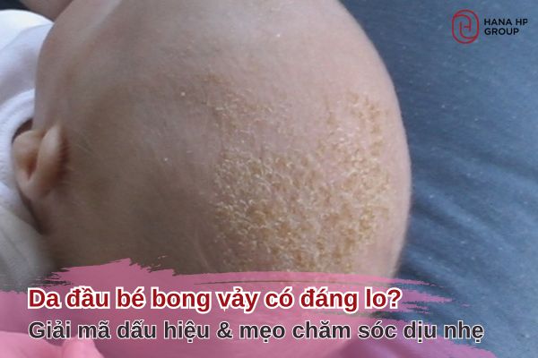 da đầu trẻ sơ sinh có vảy