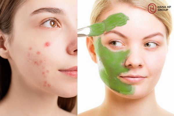 đắp mặt nạ rau ngót
