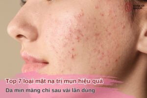 7 loại mặt nạ trị mụn hiệu quả