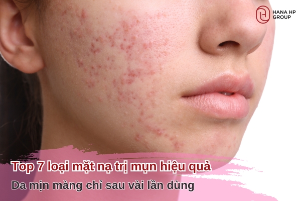 da mụn có nên đắp mặt nạ không