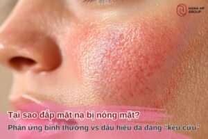 tại sao đắp mặt nạ bị nóng mặt