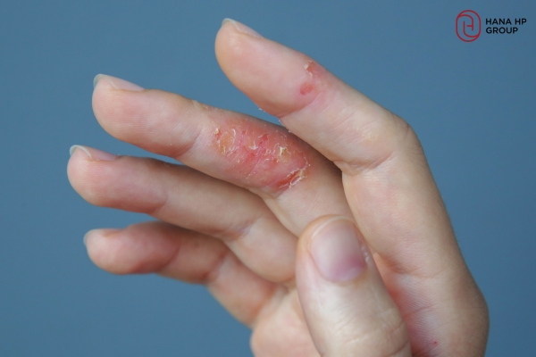 kem dưỡng ẩm cho viêm da cơ địa