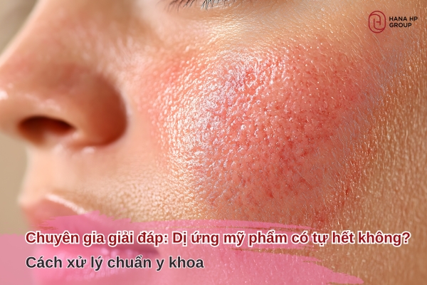 dị ứng mỹ phẩm có tự hết không