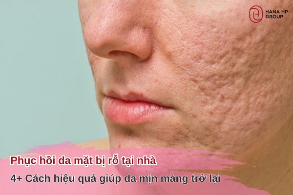 phục hồi da mặt bị rỗ