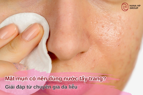 mặt mụn có nên dùng nước tẩy trang