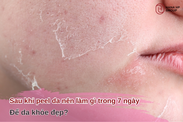 sau khi peel da nên làm gì