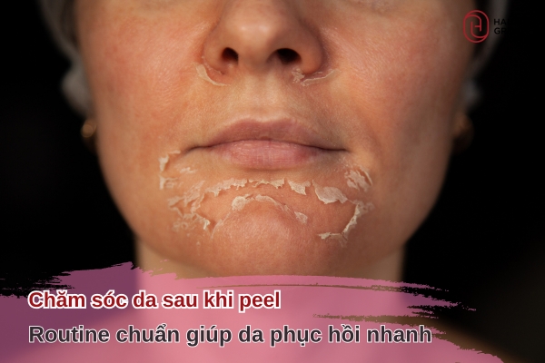 chăm sóc da sau khi peel