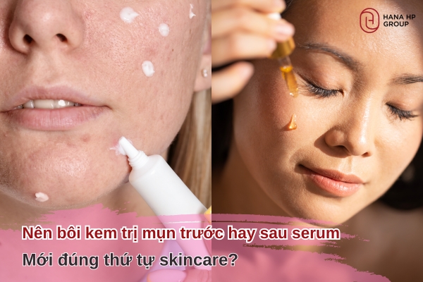 Nên bôi kem trị mụn trước hay sau serum