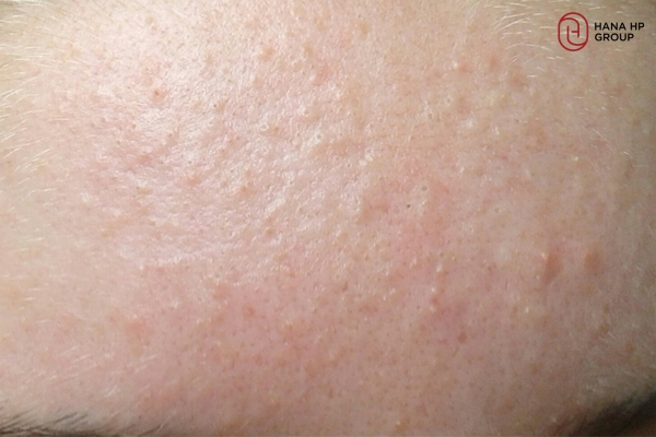 Da mụn ẩn rất dễ đẩy mụn khi dùng AHA