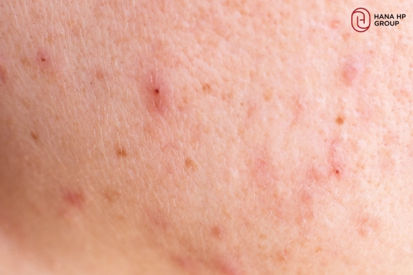 BHA cho người mới bắt đầu